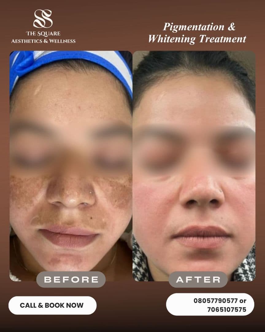 Before and after transformation at The Square Aesthetics & Wellness Clinic