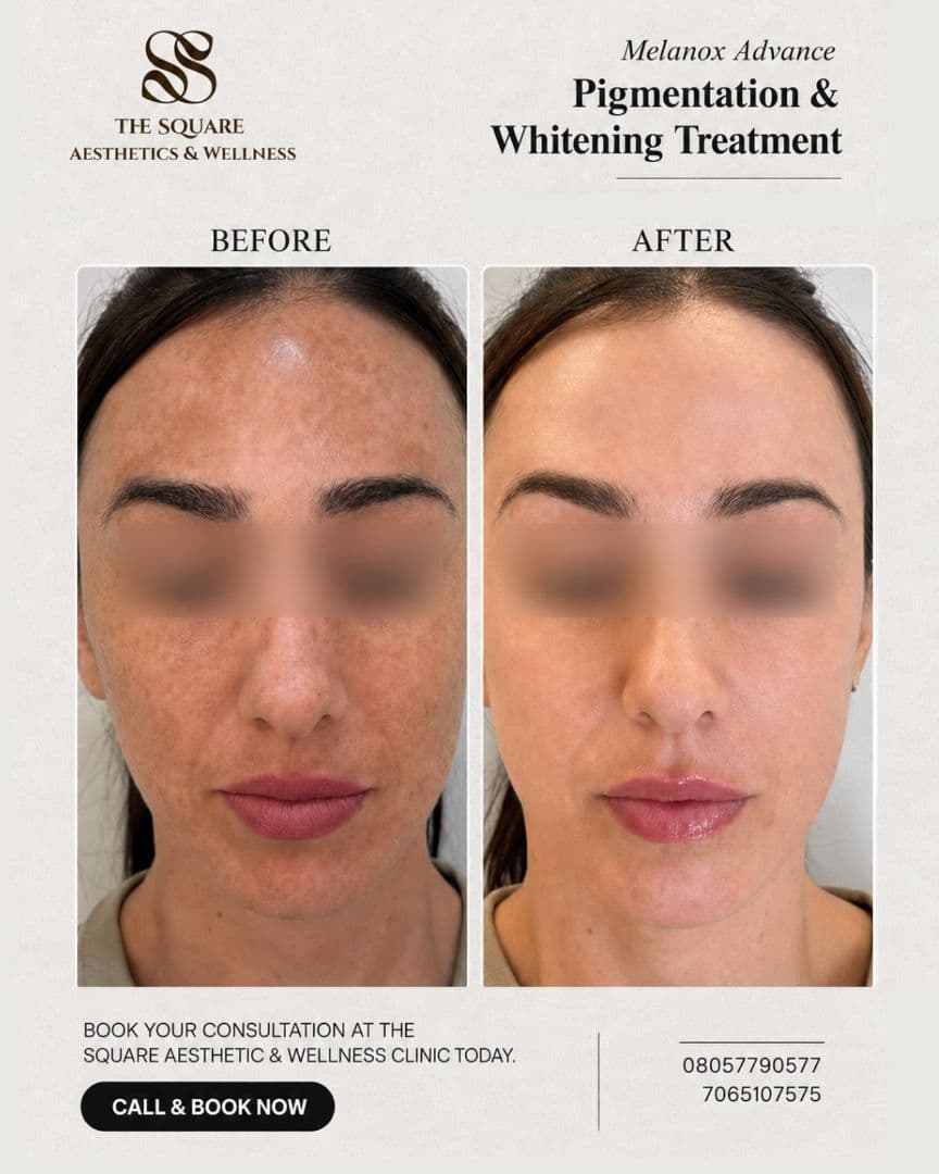 Before and after transformation at The Square Aesthetics & Wellness Clinic