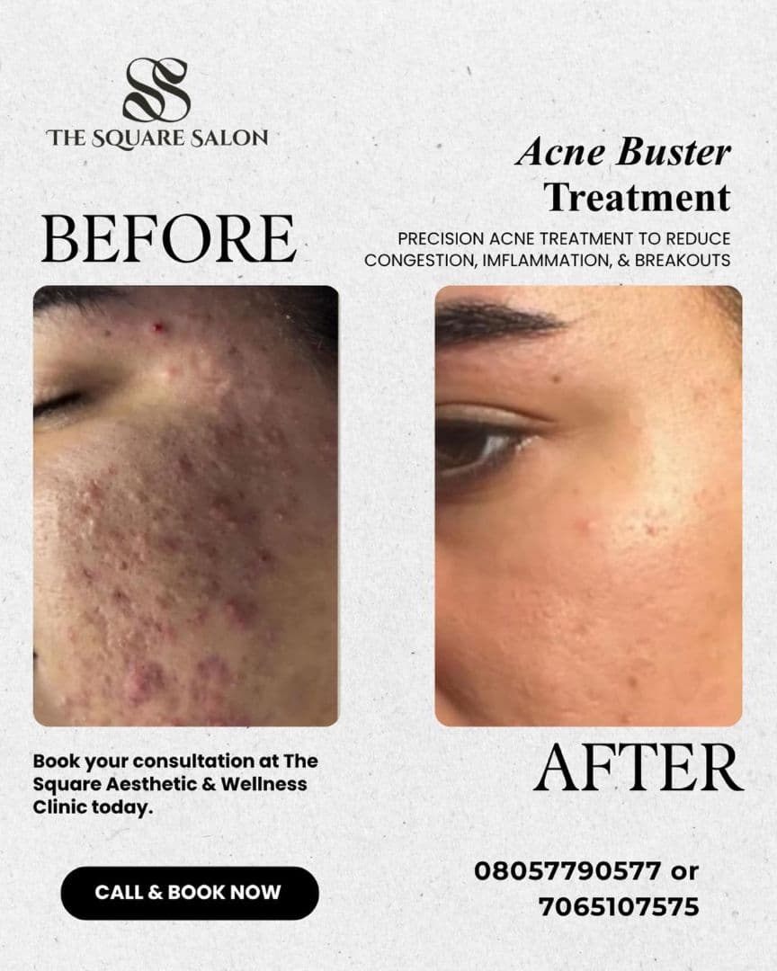 Before and after transformation at The Square Aesthetics & Wellness Clinic