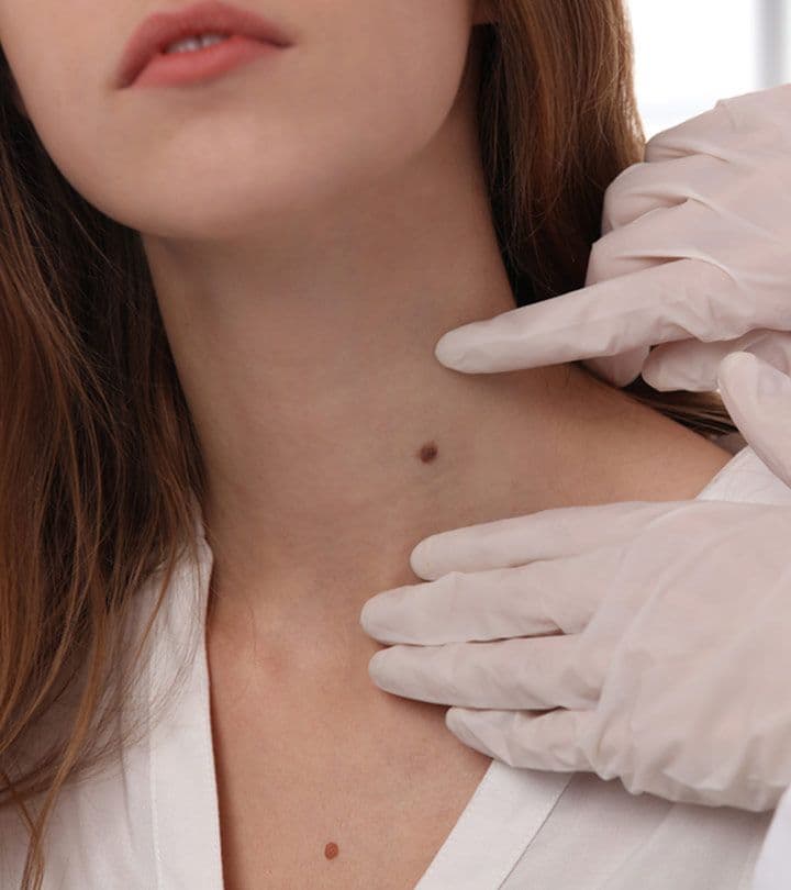 Tag & Wart Removal at The Square Aesthetics & Wellness Clinic, Rajouri Garden, Delhi